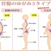 骨盤のゆがみが引き起こす不調あれこれ
