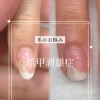 爪甲剥離症【福井/ネイル/自爪育成】