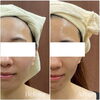 Before After「【MEIS Beauty Salon福井】フェイシャルエステで理想の美肌への第一歩！」