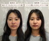 「メスを使わない整形級フェイシャルデザインとは？」