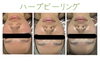 「ハーブピーリング」