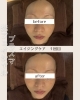 プラズマ光フェイシャル1回ビフォーアフター「before/after　1回で実感✨　～早岐フェイシャル・毛穴洗浄・リラクゼーション～」