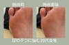 「【フットケア】足のタコにお悩みの20代女性」