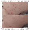 左頬の変化「10年以上悩まされたニキビ肌もここまでキレイに【福井ニキビ改善/福井ハーブピーリング/福井ニキビ跡改善】」