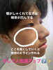頬に凹んでるのでゴルゴライン「矯正なしで🙌🏻✨」