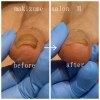 巻き爪BeforeAfter「巻き爪施術のビフォーアフターをご紹介！痛みの少ないケアで変化を実感」