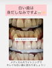 メディカルホワイトニング「白い歯は身だしなみ！メディカルホワイトニングの実力」