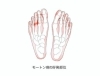 モートン病「意外と多い『モートン病』」