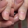 割れ爪補強Before→After「爪が割れて痛い【福山駅前】爪Labo爪のお悩み専門サロン」