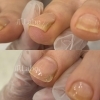 巻き爪補正Before→After「巻き爪補正【福山駅前】爪Labo爪のお悩み専門サロン」