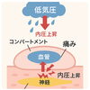 低気圧と痛み「雨の日に古傷が痛む」