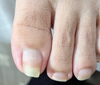 施術前「伸びすぎた足の爪や爪表面の凹凸、気になりませんか？セルフケアのポイントとご相談受付中」