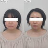 「韓国人のようなシャープな輪郭へ【 福井エステ/福井フェイシャルエステ/福井小顔サロン/韓国造顔リフト 】」