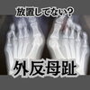 「学生時代から外反母趾で激痛に悩んで、野球に集中できなかった過去」