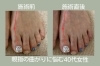 「【足整体】外反母趾にお悩みの40代女性」