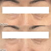 「目元の印象を変える切らない目のたるみ施術！【 福井フェイシャルエステ/目の下のたるみ/切らない目元のたるみ取り】」
