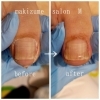 巻き爪BeforeAfter「巻き爪補正ビフォーアフター公開！食い込み・炎症が軽減した症例をご紹介」