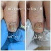 巻き爪BeforeAfter「4趾（薬指）の巻き爪補正ビフォーアフター！厚み・乾燥・食い込みが変化」