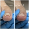 巻き爪BeforeAfter「巻き爪補正ビフォーアフター画像公開！自然なカーブと健康的な爪色へ」