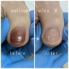 巻き爪BeforeAfter「巻き爪補正ビフォーアフター画像公開！劇的な変化と健康的な足元へ」
