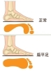偏平足は疲れます。早めに治しましょう。「「偏平足」そのままにするなっ！甘く見ていると後で痛い目に…。」