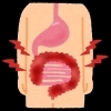 「【漢方で潰瘍性大腸炎による体調不良を改善】」
