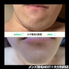 ビフォーアフター「ヒゲ脱毛5回目のビフォーアフター公開！写真で見るリアルな変化」