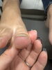 食い込みが痛い「親指の爪がホチキスのように巻く…左右非対称の巻き爪にご注意を」
