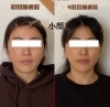 続ける事で筋肉の凝りにも変化が…「9回目の施術でここまで変化!小顔矯正のビフォーアフターをご紹介」
