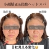 釧路で小顔矯正するならMichelle.へ！　釧路小顔