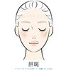 肝斑イラスト「肝斑（かんぱん）について ― 美容皮膚科のドクターと看護師の会話 ―」