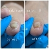 肥厚爪BeforeAfter「巻き爪・肥厚爪ケアのビフォーアフター公開！厚み解消と健康的な足元へ」