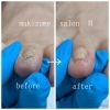肥厚爪BeforeAfter「巻き爪補正ビフォーアフター公開！厚み・乾燥・巻き込みの劇的改善」