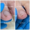 陥入爪BeforeAfter「陥入爪の施術ビフォーアフター公開！爪先端の食い込みが変化した症例」