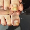 巻き爪補正初回Before→after「巻き爪補正【福山駅前】爪Labo爪のお悩み専門サロン」