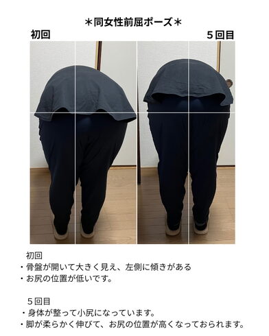 中心線に沿って、丸く小尻になっておられます。「施術5回で変化を実感!脚の伸びが良くなり、ヒップアップ効果も」