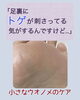 小さなウオノメでも…「【ウオノメケア】足裏にトゲが刺さった⁈」