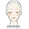 老人性色素斑のイラスト「老人性色素斑（日光性色素斑）について：美容皮膚科のドクターと 看護師の対話」