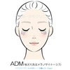 ADMのイラスト「ADM（後天性真皮メラノサイトーシス）の治療について：美容皮膚科のドクターと看護師の対話」