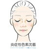 PIHのイラスト「炎症性色素沈着（PIH）の治療について：美容皮膚科のドクターと看護師の対話」