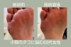 「【角質ケア】小指のタコがスッキリした60代女性」