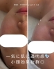 ハイドラ毛穴洗浄×光フォト×ハーブピーリング「【秋冬の大敵⚡️乾燥から肌を守り潤いながら透明感up🫧】」