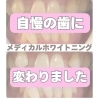 メディカルホワイトニング「【症例写真】歯が白くなると、表情まで明るく変わります！」