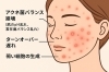 「そのニキビ、原因は一つじゃないかも？根本原因にアプローチしてニキビのできにくい肌へ」