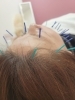「頭痛や眼精疲労にお悩みの方へ！美容鍼でスッキリ解消しませんか？✨」