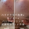 一回でもこの効果！続けていくことでより綺麗に「ニキビ改善🌿アダルトニキビも思春期ニキビも！」