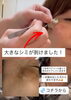 WhiteLAB「【症例写真】大きなシミが7日後にポロっと!一歩踏み出した方から変わります」