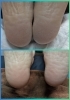 角質ケアのBefore・After🎶「かかとの角質...カサカサしていませんか😖大阪駅から2駅の足トラブルに特化したサロン👣」