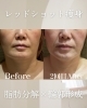 REDSHOT「レッドショットで脂肪分解×輪郭ケア！二重あご・フェイスラインのお悩みに」