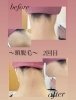 「首・あご周りの産毛スッキリ！2回目の光脱毛Before→After」